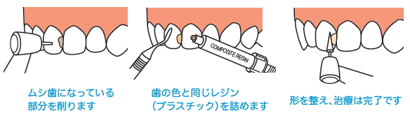 ムシ歯治療の流れ1