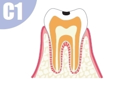 歯の表面のエナメル質にだけ穴があいたもの