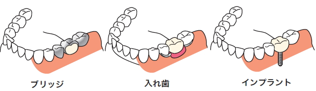 人工的な歯で補う治療