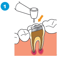 治療済みの歯の根に感染がある場合の治療の流れ