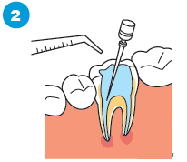 治療済みの歯の根に感染がある場合の治療の流れ