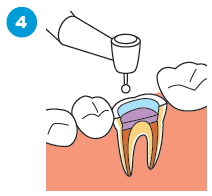 治療済みの歯の根に感染がある場合の治療の流れ4