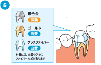 治療済みの歯の根に感染がある場合の治療の流れ5