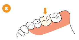 治療済みの歯の根に感染がある場合の治療の流れ8